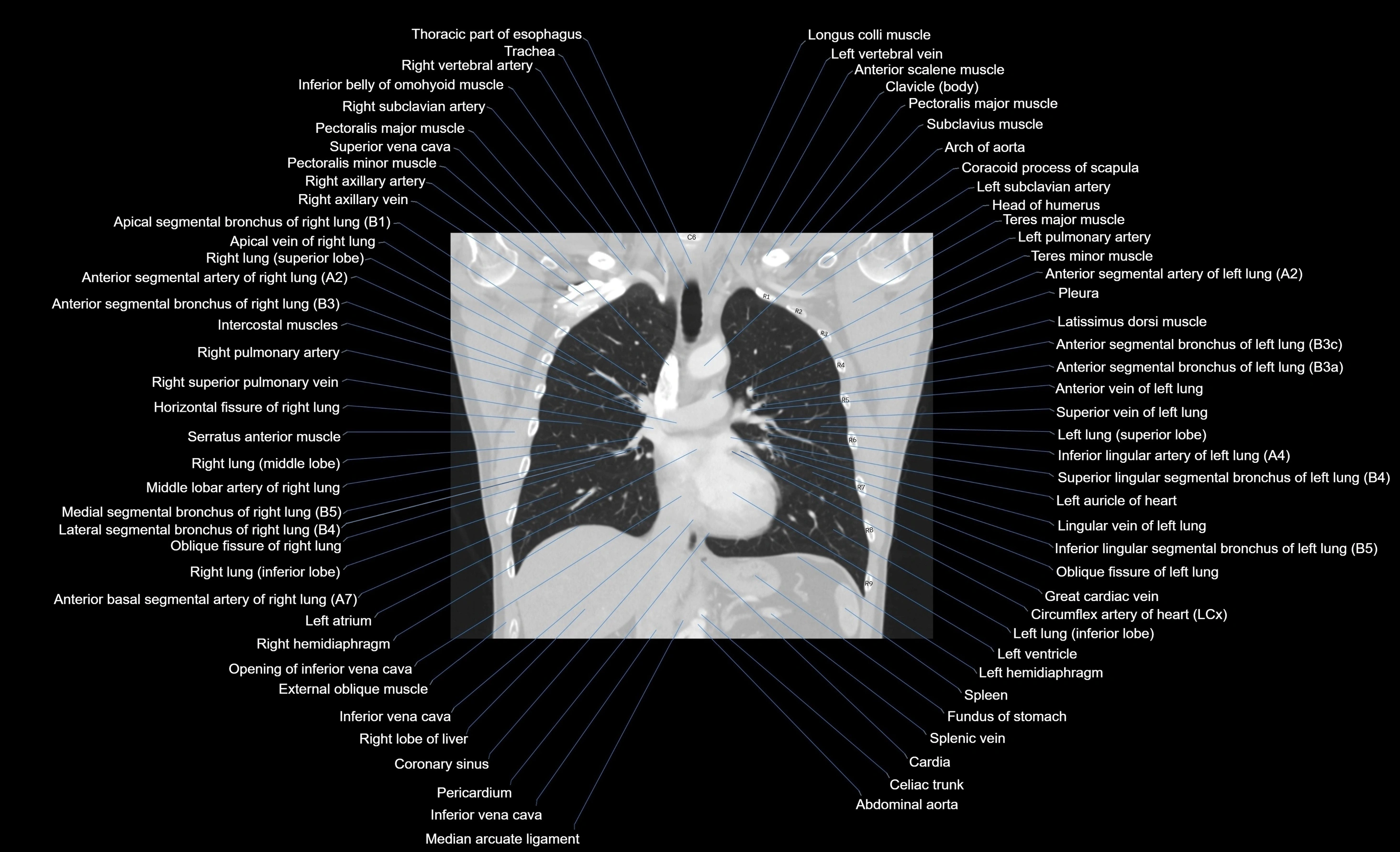 CT chest (thorax) labelled coronal cross sectional anatomy radiology image-00064.webp